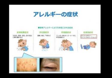 アレルギー疾患編
