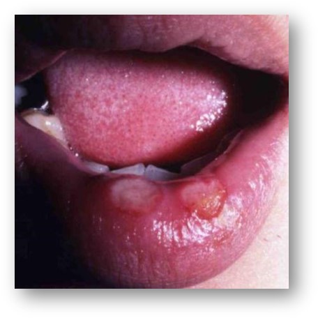 第1期梅毒の症状例